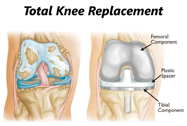 Total Knee Replacement