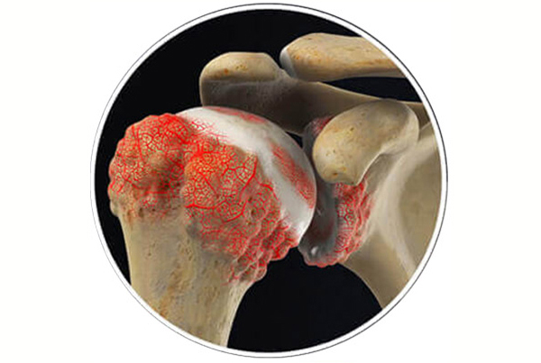 Total Shoulder Replacement