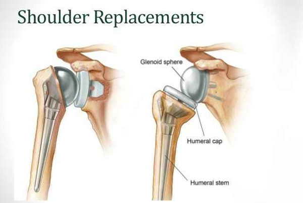 Partial Shoulder Replacement
