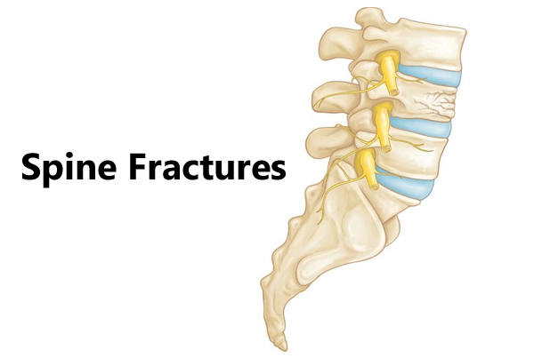 Spine Fracture