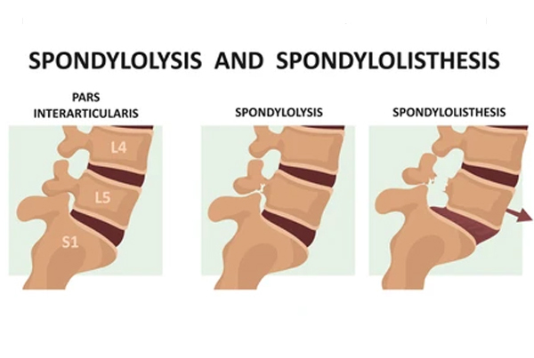 Spondylolisthesis