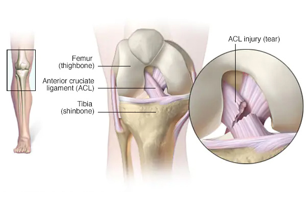 ACL Reconstruction