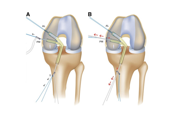 PCL Reconstruction