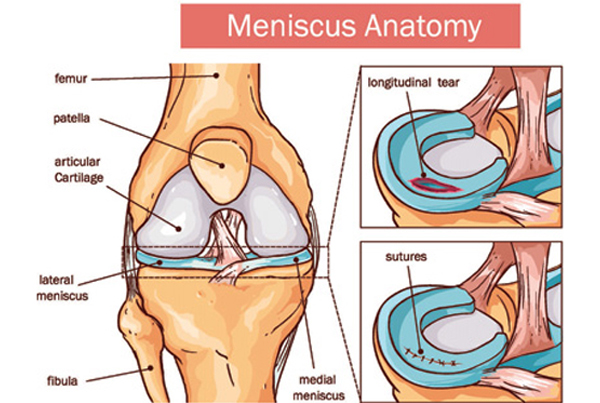 Meniscectomy