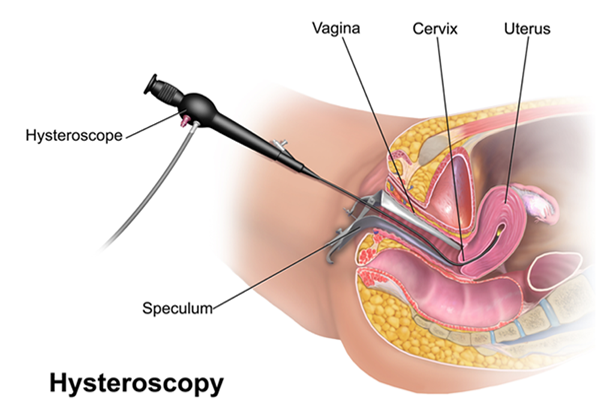 Hystrectomy