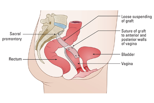 Sacrocolpopexy for Vault Prolapse