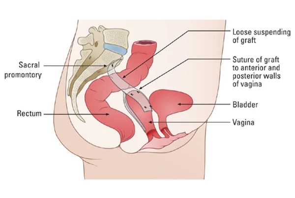 Sacrocolpopexy for Vault Prolapse