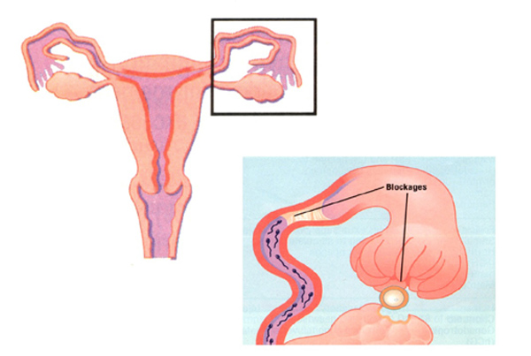 Tubal Recanalization