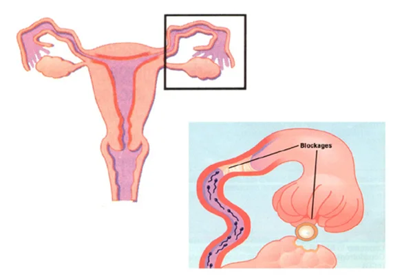 Tubal Recanalization