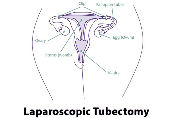 Tubectomy
