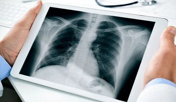 Digital X-Ray